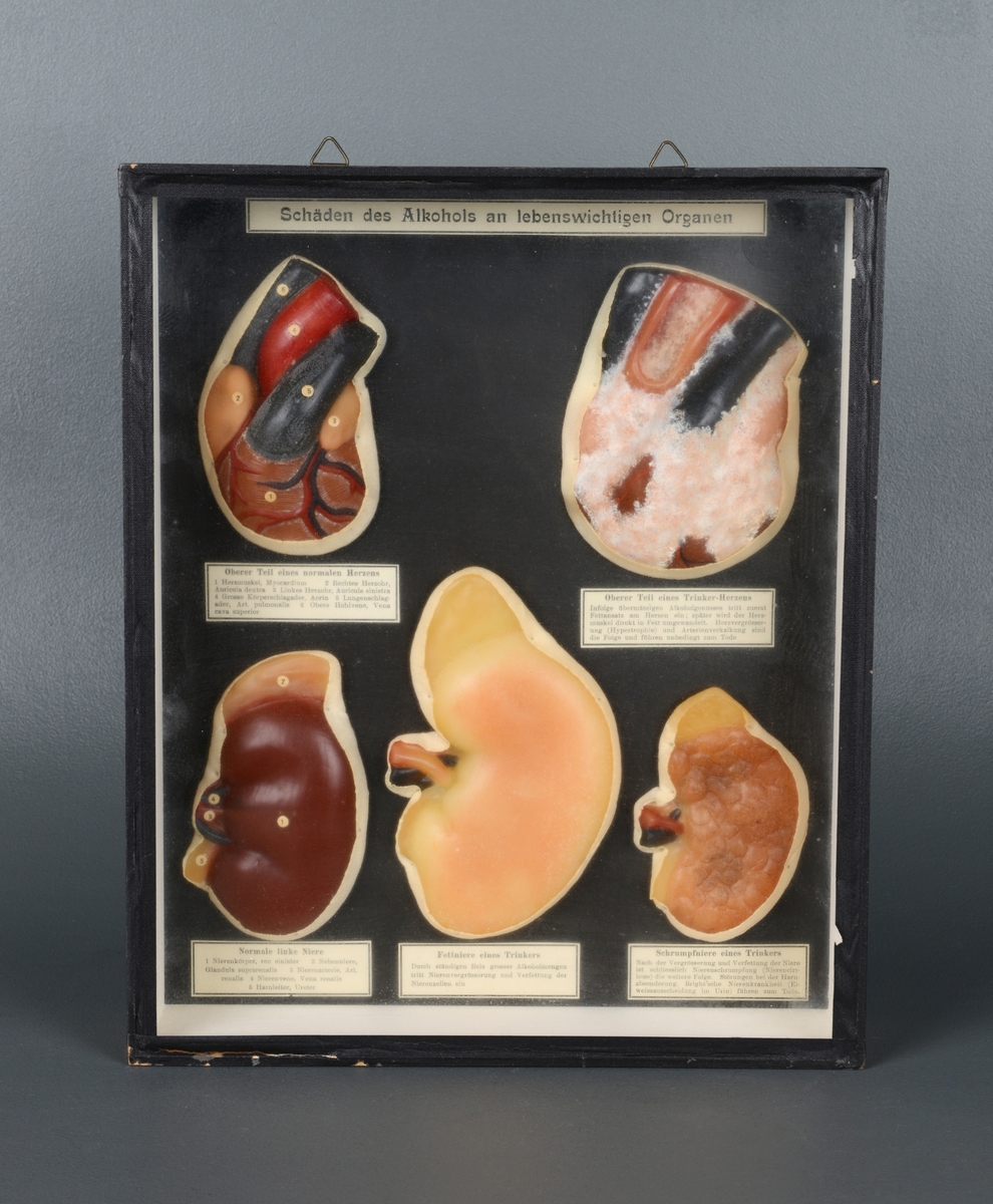 Anatomisk modell av hjerter og nyrer laget av voks. Viser alkoholskader på vitale organer. Ett vanlig hjerte og ett med alkoholskade. En vanlig nyre og to med alkoholskade. Treeske med glassplate foran og to kroker til å henges opp med.