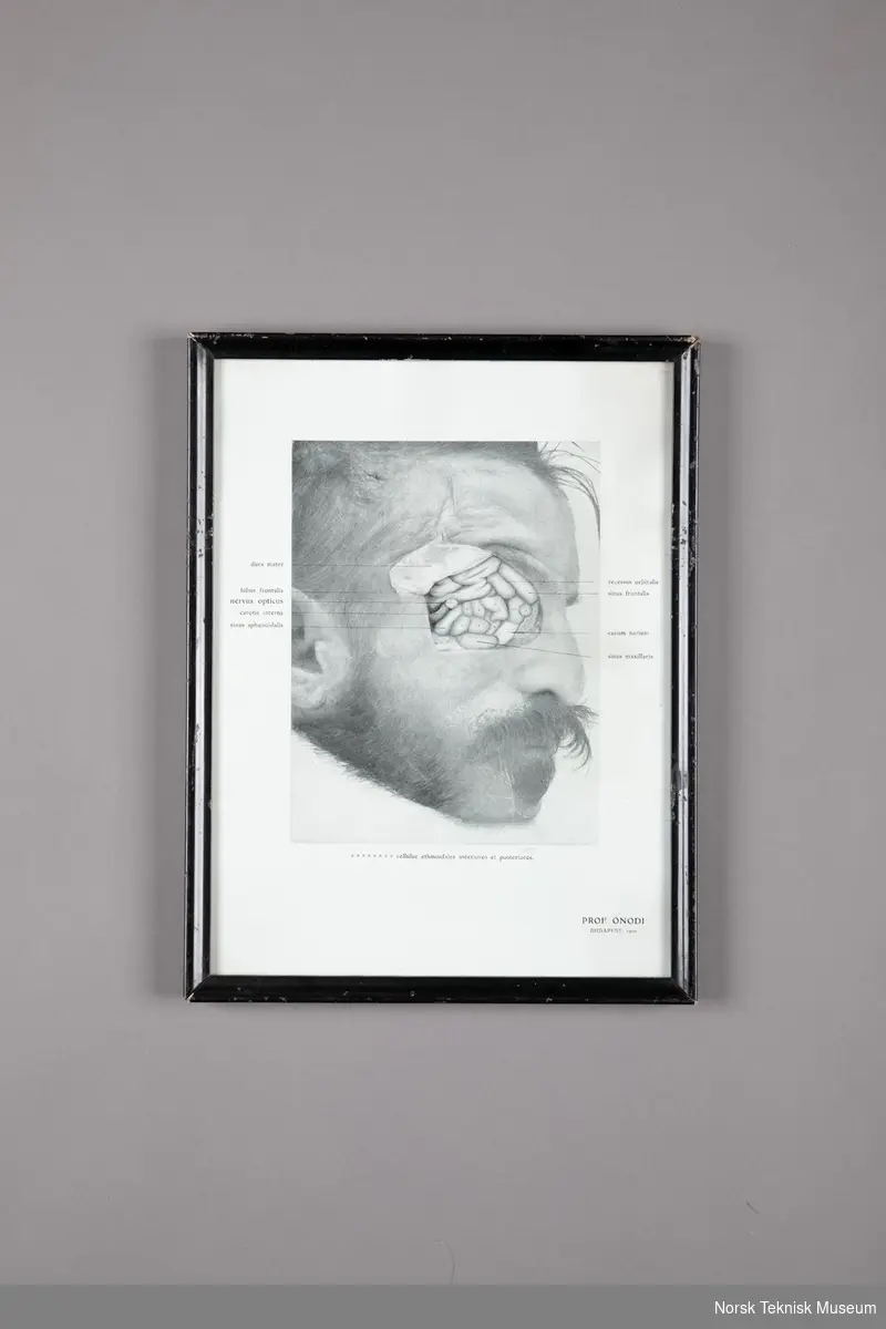 En plansje i ramme. Kompositt av et fotografi og en tegning som viser et delvis dissekert manns hode med høyre øye fjernet, utsatt bihulene og deler av hjernen bak øyet. Av Prof. Onodi, Budapest, 1906.
